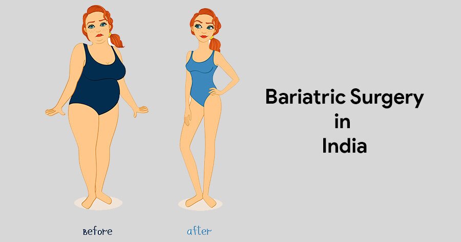 Bariatric Surgery in India